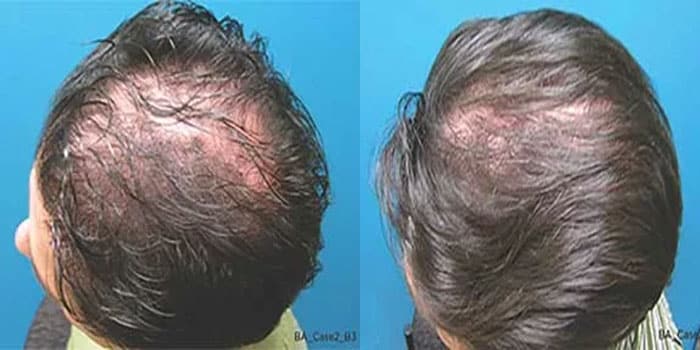 Male hair restoration patient
