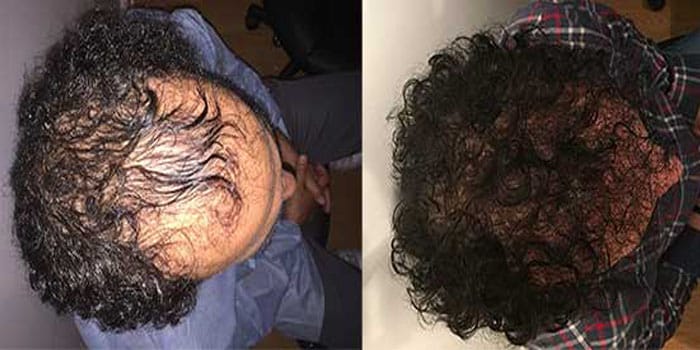 FUT before and after at Best Hair Transplant