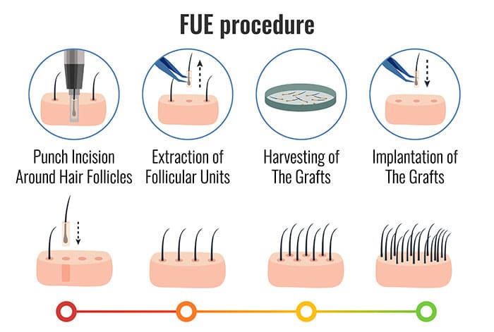 Follicular Unit Extraction at Best Hair Transplant