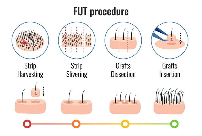 FUT transplants at Best Hair Transplants