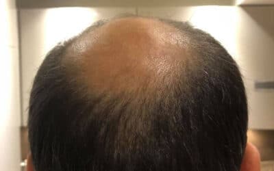 Where Can I Find the Best Hair Transplant Prices?