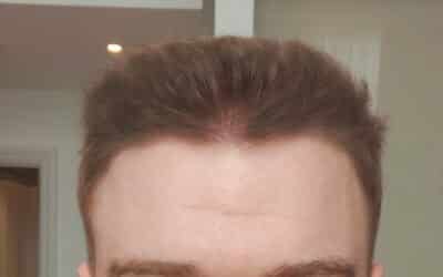 Low Cost But Never Cheap Hair Transplant in Los Angeles CA